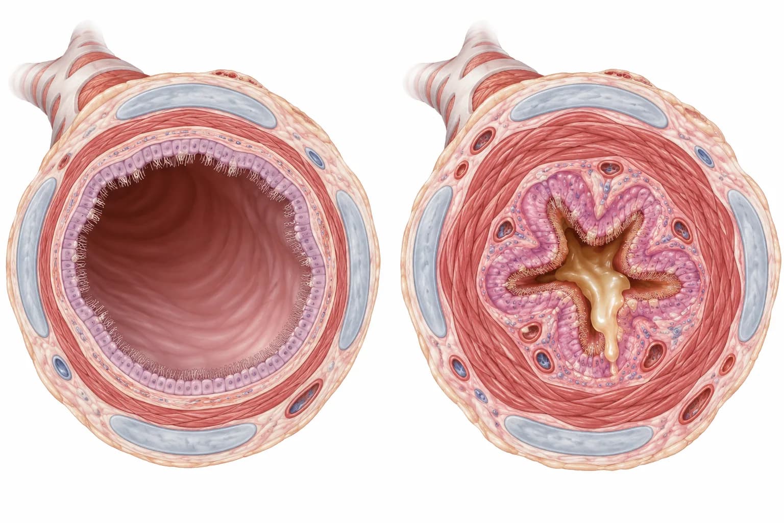 Illustration from NurseNest respiratory lessons comparing a normal open bronchiole with an asthmatic bronchiole narrowed by constricted muscle, swollen lining and mucus.